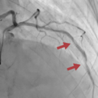 Case Sharing: A Case of Effective Lesion Modification by OAS for a Calcified Lesion in a Haemodialysis Patient with Repeated In-Stent Restenosis