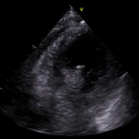 Case Sharing: A Case of Cardiogenic Shock and Cardiac Rupture after Acute Myocardial Infarction, Rescued by Impella Induction